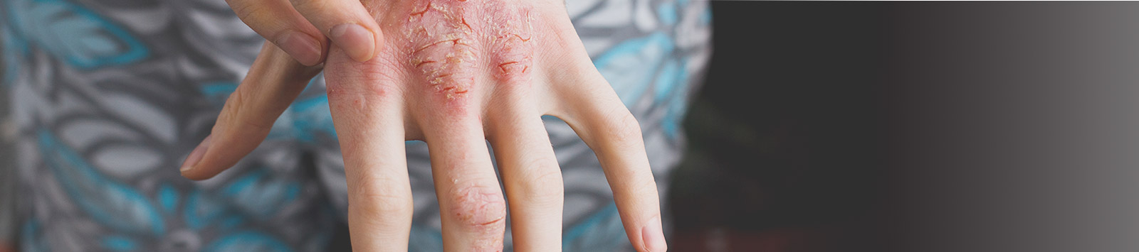 アトピー性皮膚炎の症例
